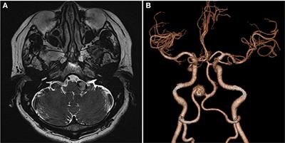 Hemifacial spasm caused by unruptured fusiform vertebral aneurysm treated with endovascular coil embolization: a case report